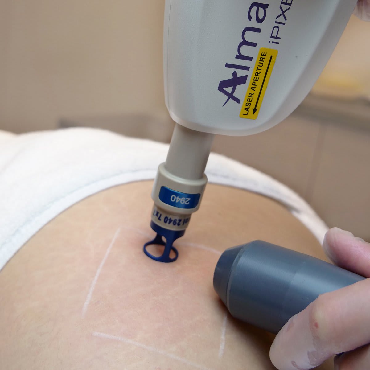 Laser treatment at TBL Medical