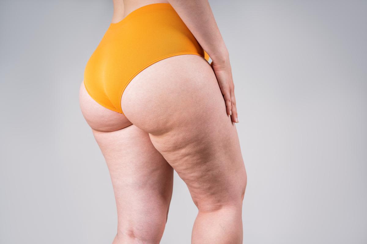 Lipedema treatment