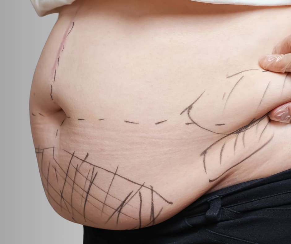 Liposuction
